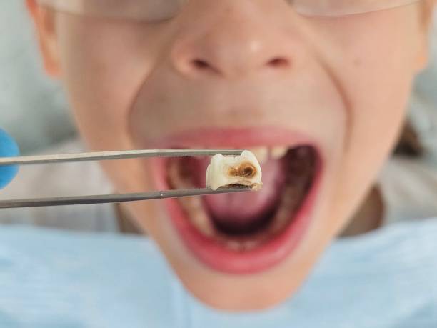 Best Emergency Treatment for Oral Infections in Bloomington, TX